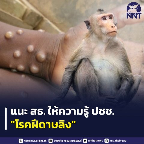 ฝีดาษลิงล่าสุด