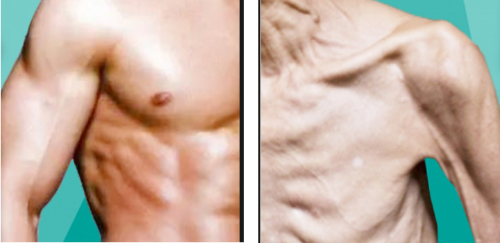 sarcopenia ในผู้สูงอายุ